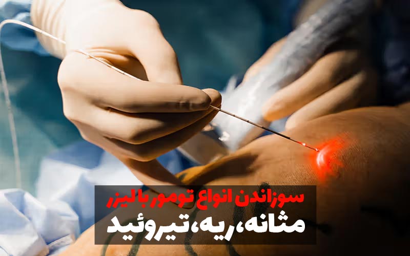 سوزاندن تومور با لیزر 1 سوزاندن تومور با لیزر